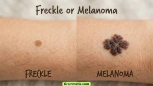 define melanotic freckle Melanoma Skin Cancer How do you tell the